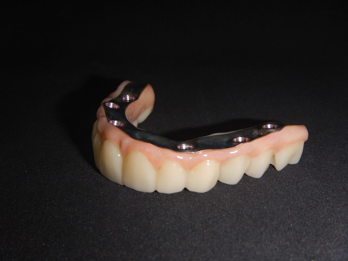 Barra híbrida de titanio con dientes acrílicos