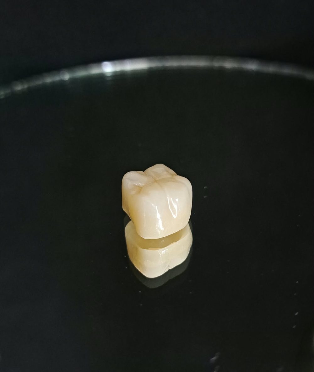 Corona de zirconio vista lateral